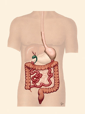 Bilio Pancreatic Diversion