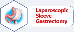 Laparoscopic Sleeve Gastrectomy